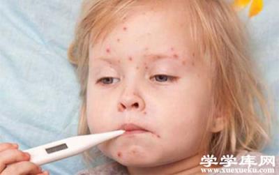 感染水痘幾天能好 水痘的癥狀和治療
