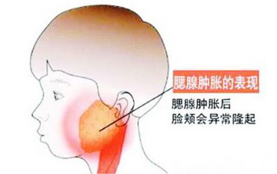 腮腺炎的早期癥狀 腮腺炎怎么治療