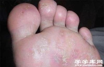 怎樣治腳氣 治療腳氣的最佳方法