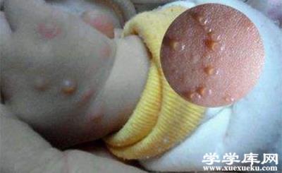 成人水痘傳染嗎 水痘的癥狀圖片