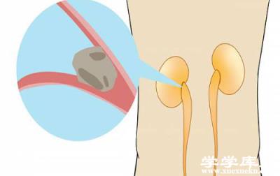 腎結石的早期癥狀 出現這些情況警惕腎結石