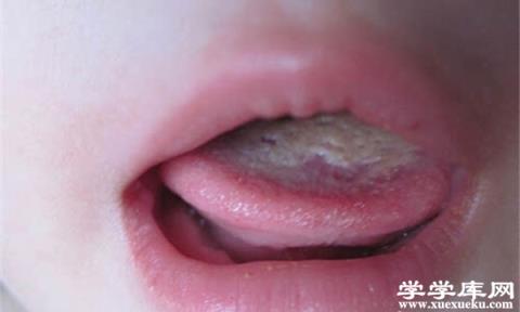 嬰兒舌苔厚白是怎么回事 嬰兒舌苔厚白怎么去除